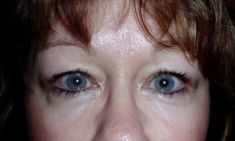 Eyelid surgery (Blepharoplasty) - Photo before - Klinika Laser Esthetic