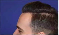 Haartransplantation - Vorher Foto - Prohaarklinik
