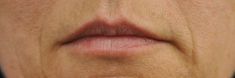 Dermal fillers - Photo before - MUDr. Jiřina Šilhánková