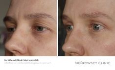 Eyelid surgery (Blepharoplasty) - Photo before - Bieńkowscy Clinic®