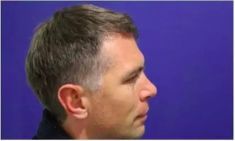 Haartransplantation - Vorher Foto - Prohaarklinik