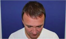 Haartransplantation - Vorher Foto - Prohaarklinik