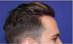 Haartransplantation - Vorher Foto - Prohaarklinik