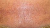 Radiofrequency Rejuvenation (Aluma, accent, TriPollar, Spa RF device, Re-Age) - Photo before - Klinika Laser Esthetic