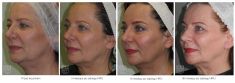 Ultherapy - Photo before - Dr n. med. Marcin Bieńkowski