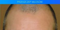 Hair Transplant - Photo before - Dr Turowski Hair Restoration Clinic