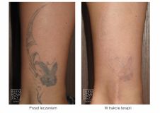 Tattoo removal - Photo before - Bieńkowscy Clinic®