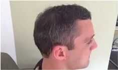 Haartransplantation - Vorher Foto - Prohaarklinik