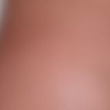 Liposuction - Photo before - Klinika Laser Esthetic