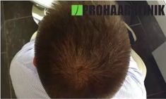 Haartransplantation - Vorher Foto - Prohaarklinik