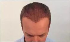 Haartransplantation - Vorher Foto - Prohaarklinik