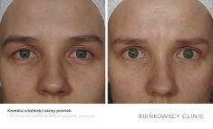 Eyelid surgery (Blepharoplasty) - Photo before - Bieńkowscy Clinic®