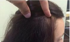 Haartransplantation - Vorher Foto - Prohaarklinik