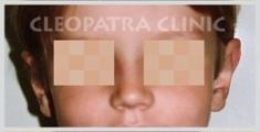 Ear surgery (Otoplasty) - Photo before - Cleopatra Clinic, Klinika Plastické Chirurgie s.r.o.