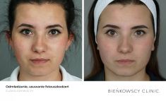 Spider veins laser removal (redness, birh marks) - Photo before - Bieńkowscy Clinic®