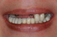 Dental implants - Photo before - Dr. Alex Farnoosh D.M.D., M.S.D., Ph.D.