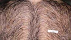 Laser hair removal - Photo before - Klinika Laser Esthetic