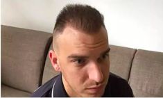 Haartransplantation - Vorher Foto - Prohaarklinik