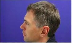 Haartransplantation - Vorher Foto - Prohaarklinik