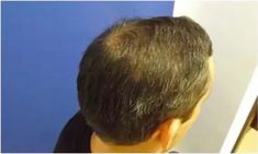 Haartransplantation - Vorher Foto - Prohaarklinik
