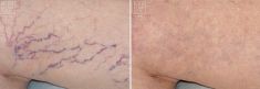 Spider veins laser removal (redness, birh marks) - Photo before - Bieńkowscy Clinic®