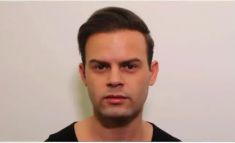 Haartransplantation - Vorher Foto - Prohaarklinik