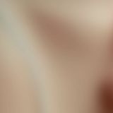 Breast Augmentation - Breast Implants - Photo before - Adam J. Rubinstein M.D., FACS