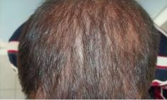 Haartransplantation - Vorher Foto - Prohaarklinik