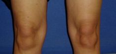 Liposuction - Photo before - Klinika Laser Esthetic