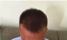 Haartransplantation - Vorher Foto - Prohaarklinik