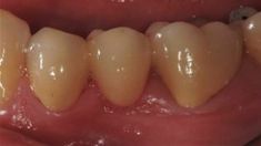 Dental crowns and bridges - Photo before - Bob W. Deason, D.D.S., PA