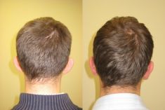 Ear surgery (Otoplasty) - Photo before - ARS ESTETICA – Klinika Medycyny Estetycznej i Laseroterapii
