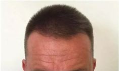 Haartransplantation - Vorher Foto - Prohaarklinik