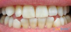 Teeth whitening - Photo before - Just Smile - Toronto Dental Hygienists