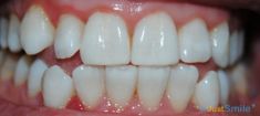 Teeth whitening - Photo before - Just Smile - Toronto Dental Hygienists