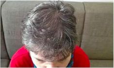 Haartransplantation - Vorher Foto - Prohaarklinik