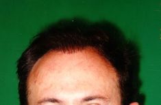 Implante capilar - Foto Antes de - Dr. Aristides Arellano-Huacuja