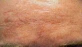 Radiofrequency Rejuvenation (Aluma, accent, TriPollar, Spa RF device, Re-Age) - Photo before - Klinika Laser Esthetic