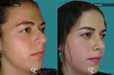 Cirugía de la nariz (Rinoplastia) - Paciente con nariz grande y Rinocifosis después de la rinoplastia vemos una nariz natural armónica al rostro