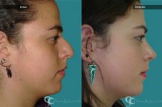 Cirugía de la nariz (Rinoplastia) - Paciente con nariz grande y Rinocifosis después de la rinoplastia vemos una nariz natural armónica al rostro