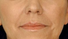 Injekční výplně - fotka před - Esthé Laser Clinic
