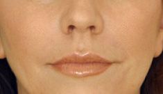 Injekční výplně - fotka před - Esthé Laser Clinic