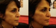 Dermal fillers - Photo before - Dr Emmanuel Elard