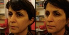 Dermal fillers - Photo before - Dr Emmanuel Elard