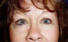 Eyelid surgery (Blepharoplasty) - Photo before - Klinika Laser Esthetic