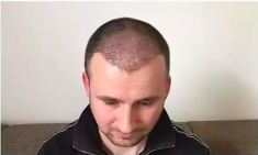 Haartransplantation - Vorher Foto - Prohaarklinik