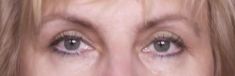 Eyelid surgery (Blepharoplasty) - Photo before - Klinika Laser Esthetic
