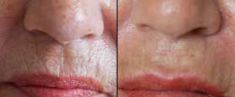 Dermal fillers - Photo before - Tracey Bell Clinic