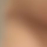 Breast Augmentation - Breast Implants - Photo before - Adam J. Rubinstein M.D., FACS