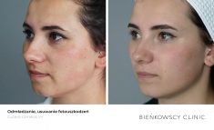 Spider veins laser removal (redness, birh marks) - Photo before - Bieńkowscy Clinic®